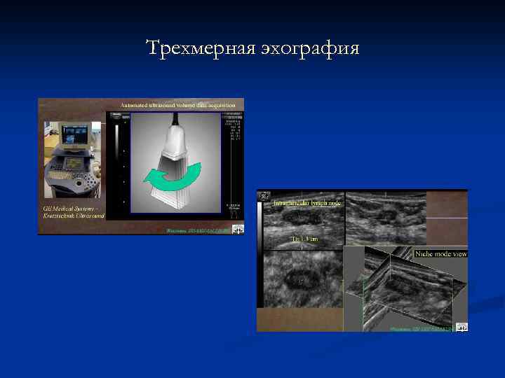 Трехмерная эхография 