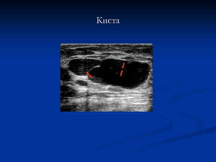 Киста 