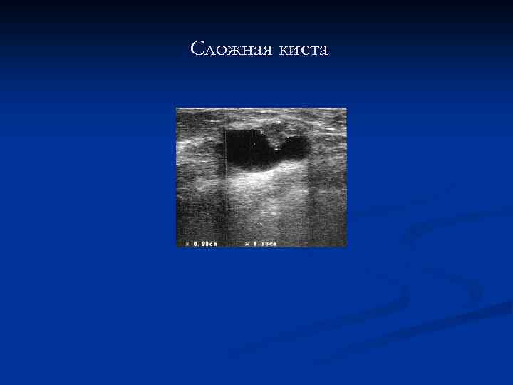 Сложная киста 