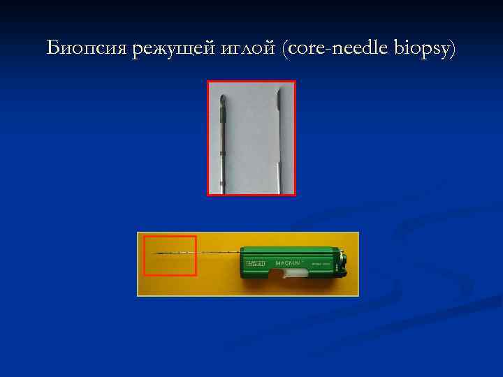 Биопсия режущей иглой (core-needle biopsy) 