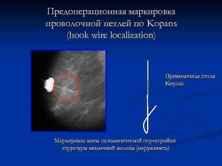 Предоперационная маркировка проволочной петлей по Kopans (hook wire localization) Проволочная петля Kopans Маркировка зоны