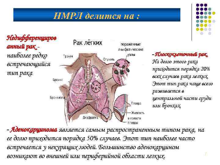 НМРЛ делится на : Недифференциров анный рак наиболее редко встречающийся тип рака - Плоскоклеточный