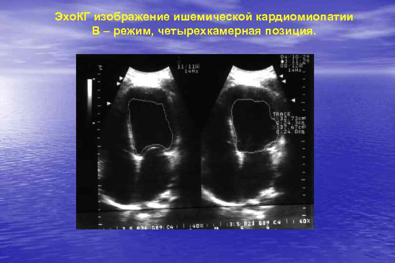 Эхо. КГ изображение ишемической кардиомиопатии В – режим, четырехкамерная позиция. 
