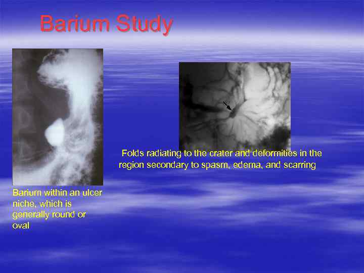 Barium Study Folds radiating to the crater and deformities in the region secondary to