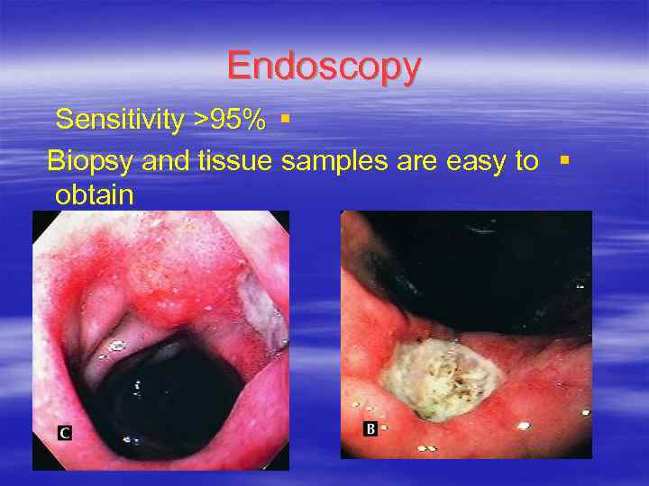Endoscopy Sensitivity >95% § Biopsy and tissue samples are easy to § obtain 