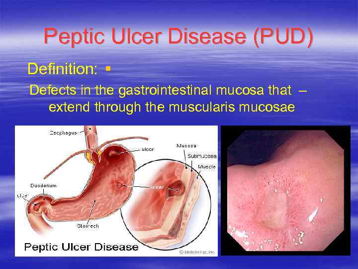 Peptic Ulcer Disease (PUD) Definition: § Defects in the gastrointestinal mucosa that – extend