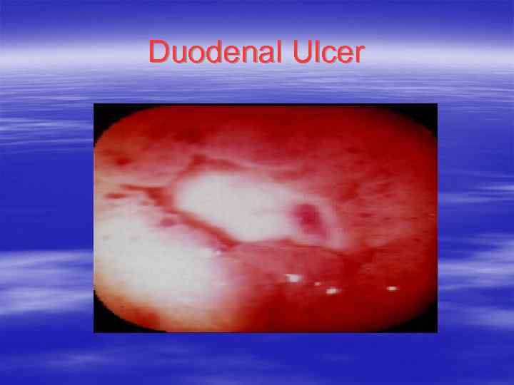 Duodenal Ulcer 