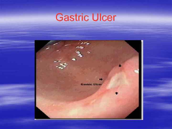 Gastric Ulcer 