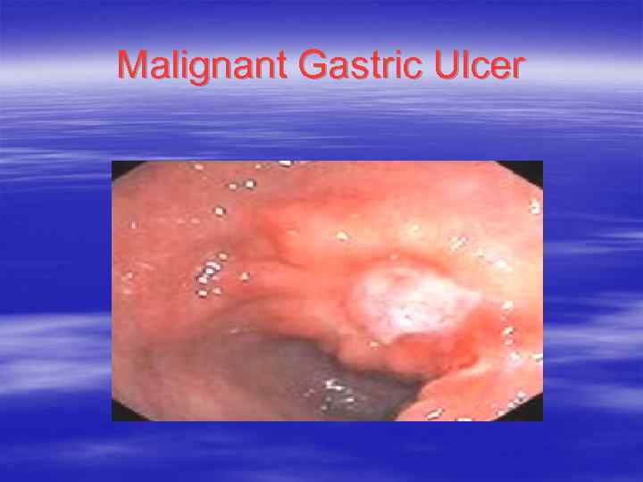 Malignant Gastric Ulcer 