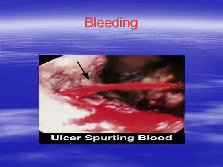 Bleeding 