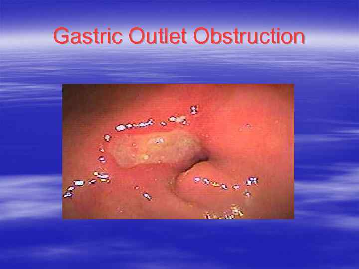 Gastric Outlet Obstruction 