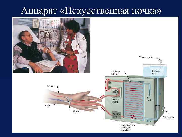 Аппарат «Искусственная почка» 