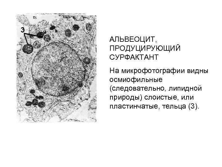3 АЛЬВЕОЦИТ, ПРОДУЦИРУЮЩИЙ СУРФАКТАНТ На микрофотографии видны осмиофильные (следовательно, липидной природы) слоистые, или пластинчатые,