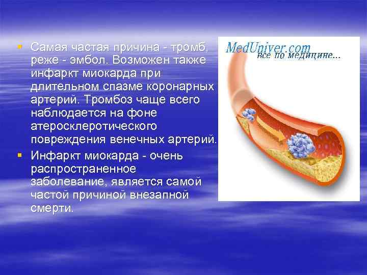 § Самая частая причина тромб, реже эмбол. Возможен также инфаркт миокарда при длительном спазме