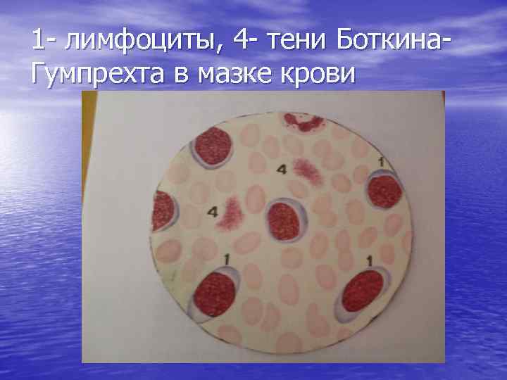 1 - лимфоциты, 4 - тени Боткина. Гумпрехта в мазке крови 