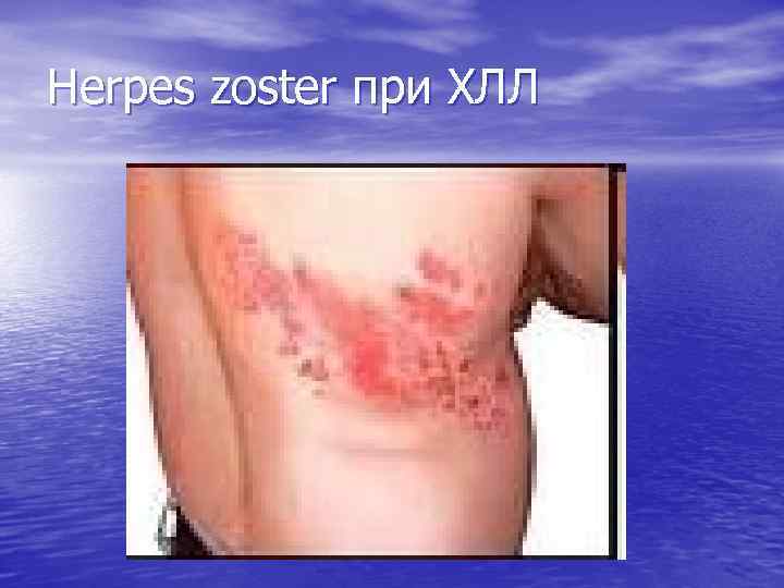 Herpes zoster при ХЛЛ 