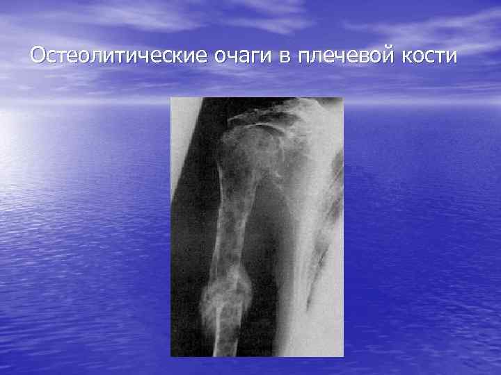 Метастатическое поражение кости. Остеолитическая деструкция кости что это. Метастазы в костях остеолитические очаги. Остеолитический очаг в правой бедренной кости. Остеолитическое поражение костей.