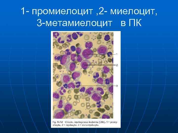 1 - промиелоцит , 2 - миелоцит, 3 -метамиелоцит в ПК 