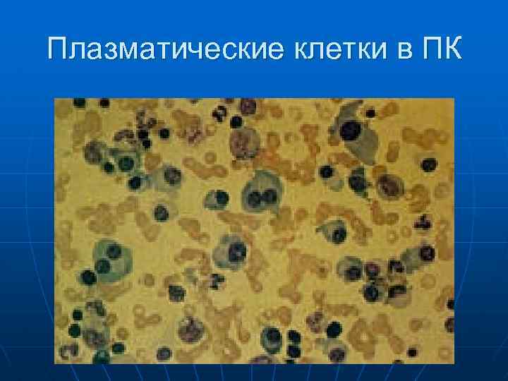 Плазматические клетки в ПК 