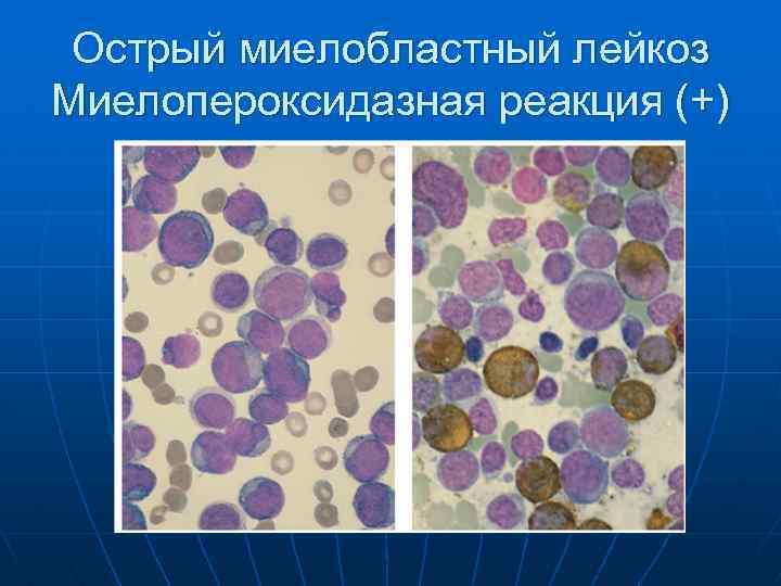 Хронический миеломоноцитарный лейкоз