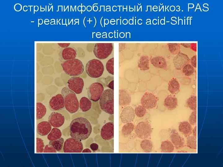 Острый лимфобластный лейкоз. Острый лимфобластный лейкоз pas. Острый лимфолейкоз миелограмма.