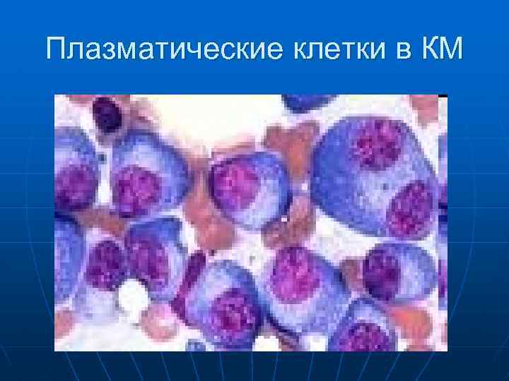 Плазматические клетки в КМ 