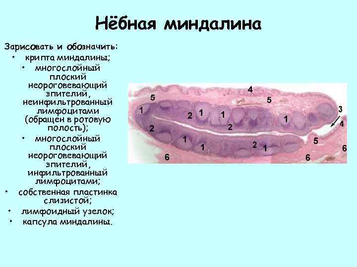 Нёбная миндалина Зарисовать и обозначить: • крипта миндалины; • многослойный плоский неороговевающий эпителий, неинфильтрованный