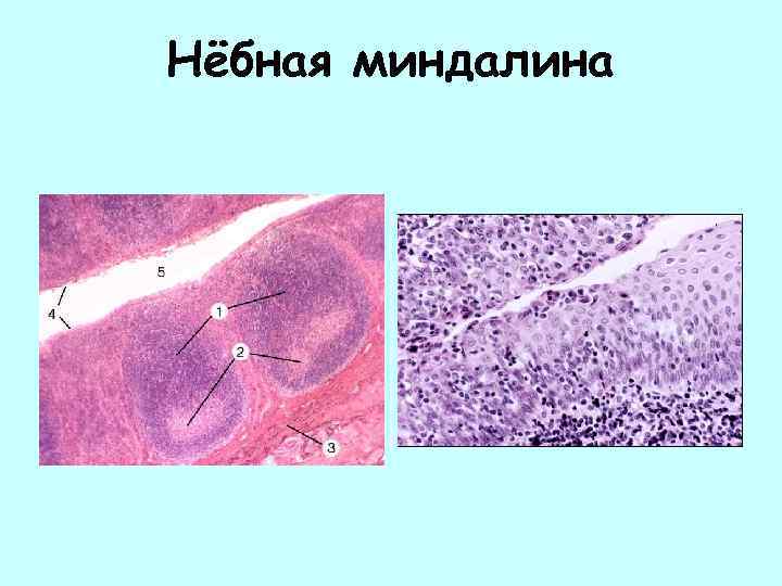 Нёбная миндалина 