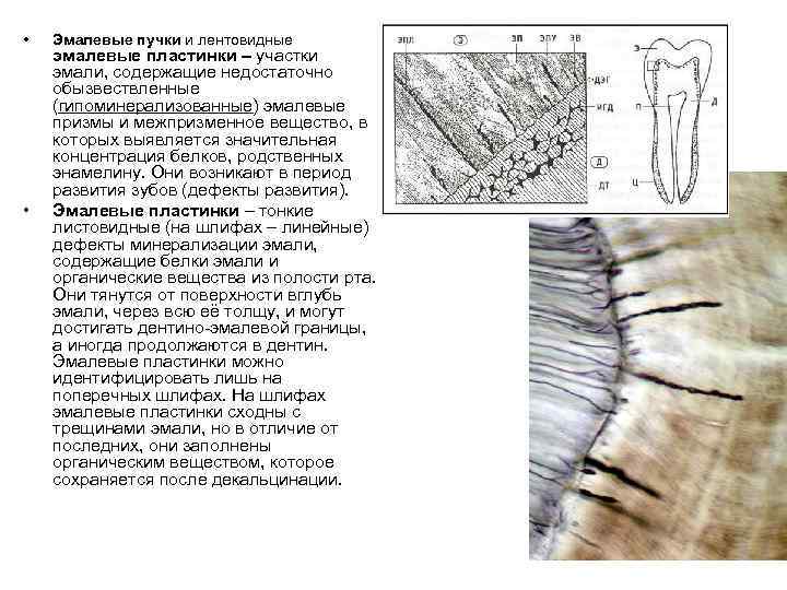  • • Эмалевые пучки и лентовидные эмалевые пластинки – участки эмали, содержащие недостаточно