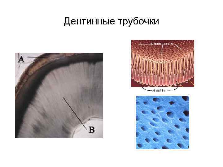 Дентинные трубочки 