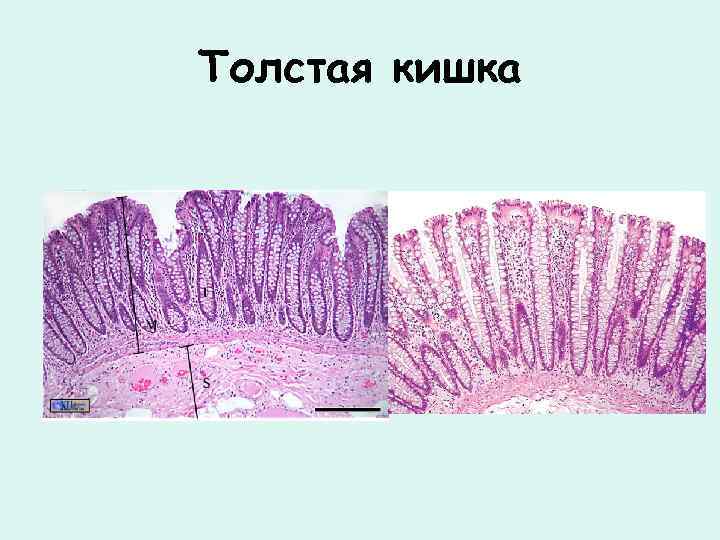 Толстая кишка 