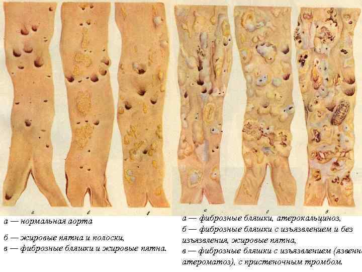 а — нормальная аорта б — жировые пятна и полоски, в — фиброзные бляшки