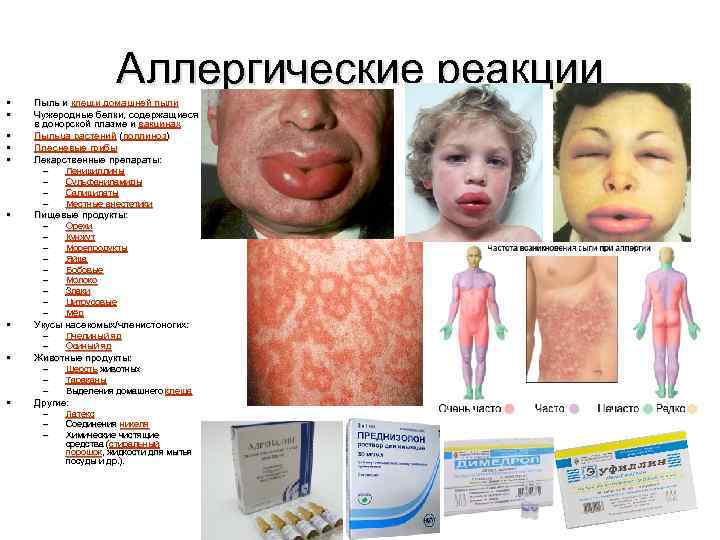 Аллергические реакции • • • Пыль и клещи домашней пыли Чужеродные белки, содержащиеся в