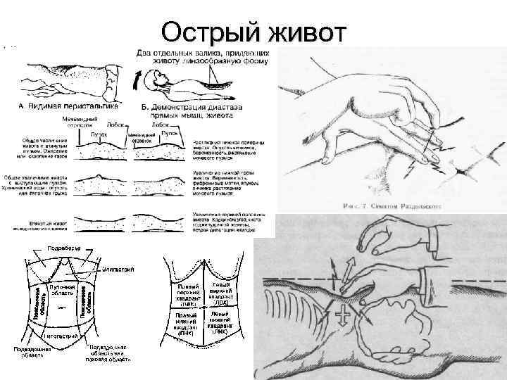 Острый живот 