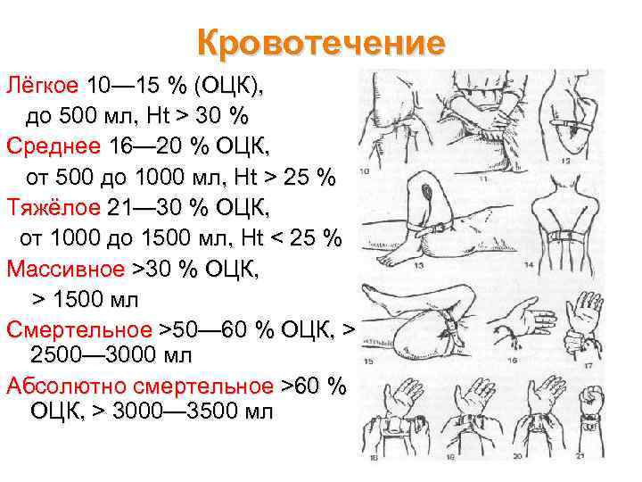 Легкая кровопотеря. Кровотечения ОЦК. Кровотечение легкая степень.