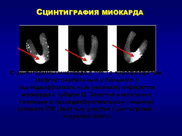 СЦИНТИГРАФИЯ МИОКАРДА Сцинтиграммы миокарда с 99 m Тс-пирофосфатом, зарегистрированные у больного с заднедиафрагмальным (нижним)