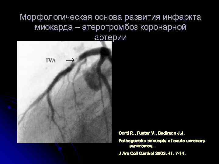 Морфологическая основа развития инфаркта миокарда – атеротромбоз коронарной артерии Corti R. , Fuster V.