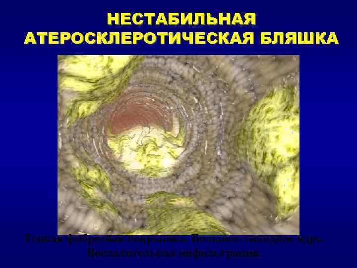 НЕСТАБИЛЬНАЯ АТЕРОСКЛЕРОТИЧЕСКАЯ БЛЯШКА Тонкая фиброзная покрышка. Большое липидное ядро. Воспалительная инфильтрация. 