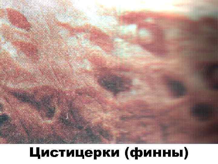 Цистицерки (финны) 