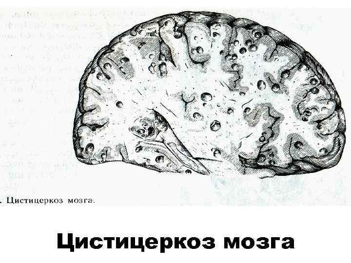 Цистицеркоз мозга 