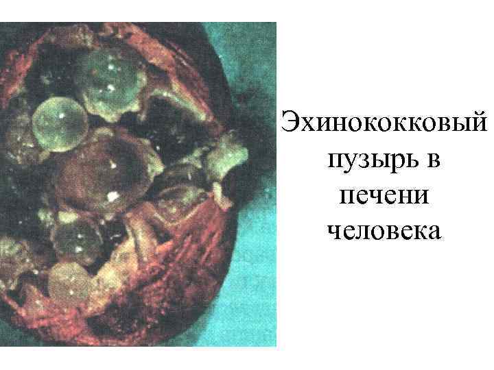 Эхинококковый пузырь в печени человека 