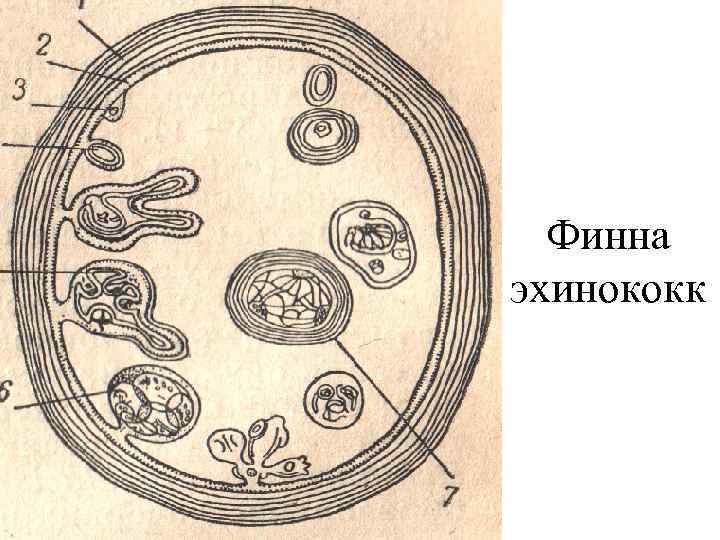 Финна эхинококк 