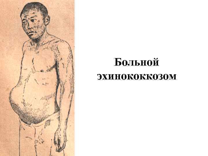 Больной эхинококкозом 