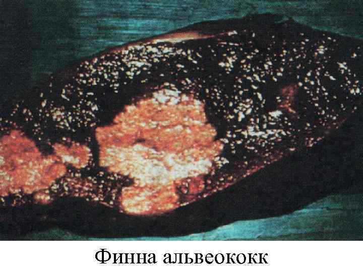 Финна альвеококк 