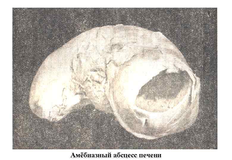 Амёбиазный абсцесс печени 