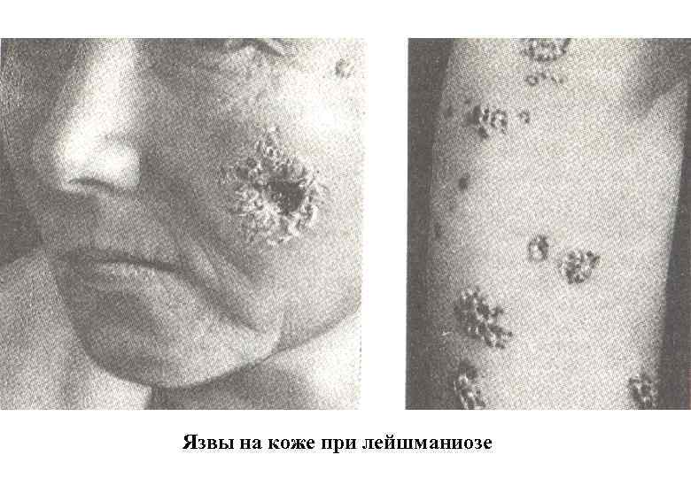 Язвы на коже при лейшманиозе 