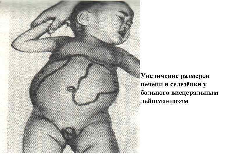 Увеличение размеров печени и селезёнки у больного висцеральным лейшманиозом 