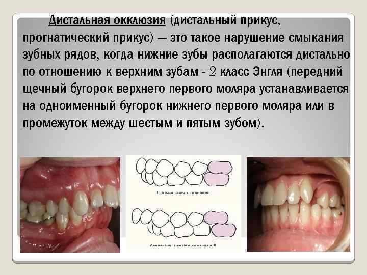 Дистальная окклюзия (дистальный прикус, прогнатический прикус) — это такое нарушение смыкания зубных рядов, когда
