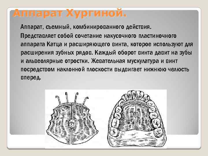 Аппарат Хургиной. Аппарат, съемный, комбинированного действия. Представляет собой сочетание накусочного пластиночного аппарата Катца и