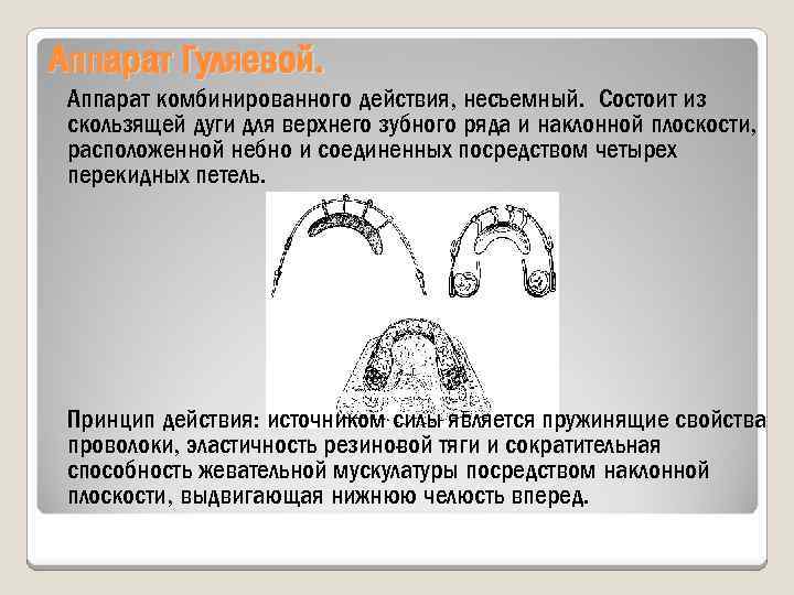 Аппарат Гуляевой. Аппарат комбинированного действия, несъемный. Состоит из скользящей дуги для верхнего зубного ряда